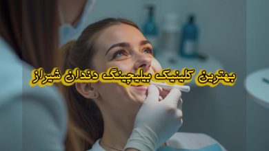 بهترین دکتر بلیچینگ دندان در شیراز